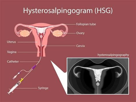 Hysterosalpingography explained