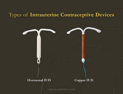 IUD device