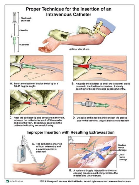 IV insertion process