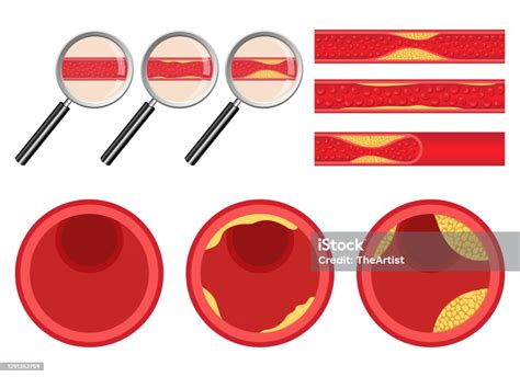 Ilustrasi arteriosklerosis