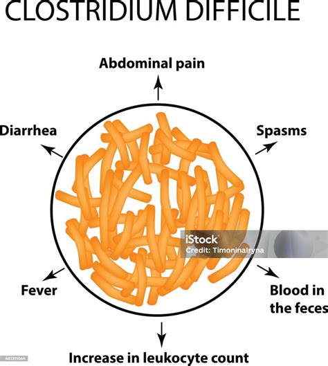 Infeksi Clostridium difficile