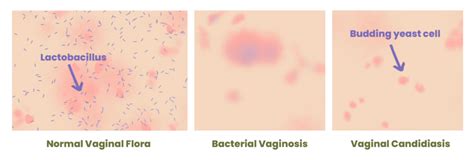 Infeksi Vagina