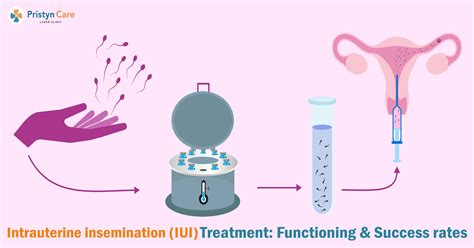 Intrauterine Insemination (IUI)