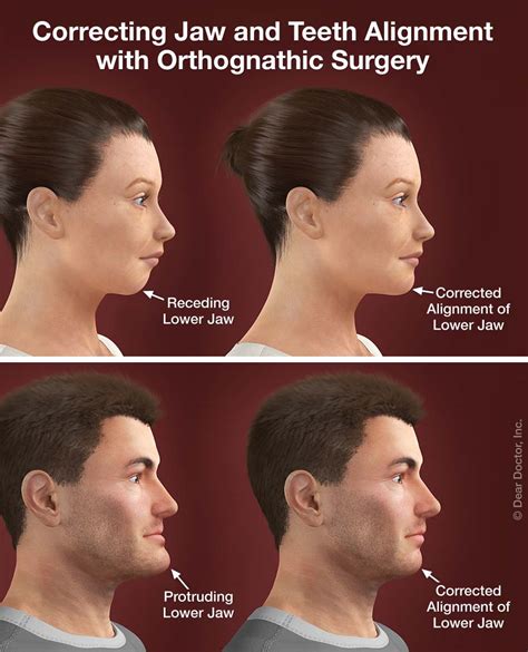 Jaw Surgery Treatments for Uneven Jaw