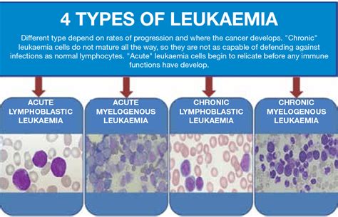 Jenis leukemia