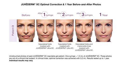 Juvederm Filler Chart