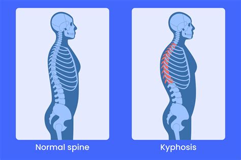 Kifosis Postural