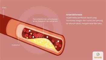 Komplikasi arteriosklerosis