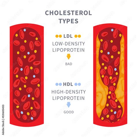 LDL cholesterol buildup