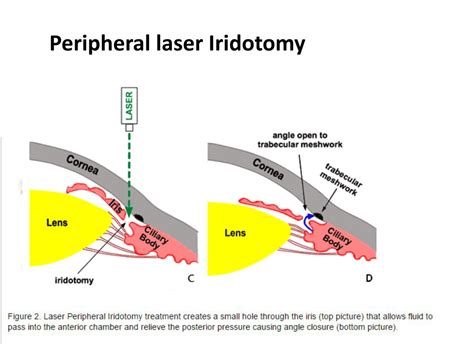Laser Iridotomi