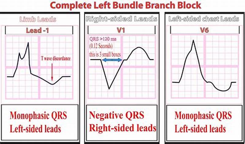 Left Bundle Branch Block Pattern