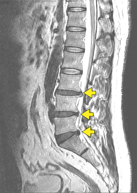 MRI