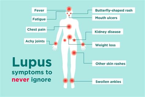 Lupus