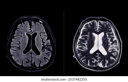 MRI brain scan