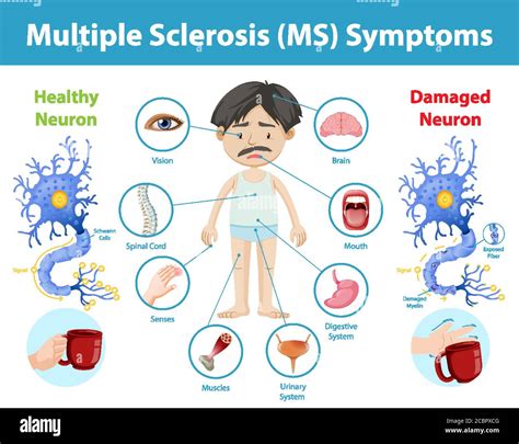 Multiple Sclerosis Sy… 