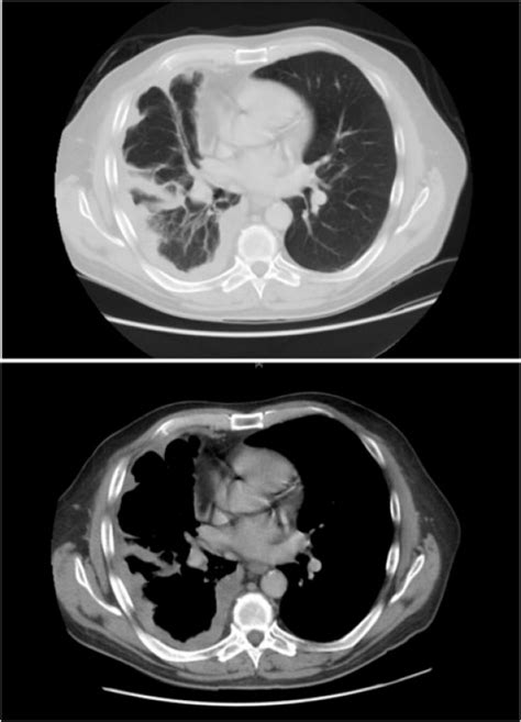 Mesothelioma CT Scan