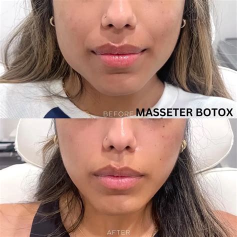 Masseter Botox Improved Concentration