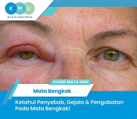 Mata Bengkak