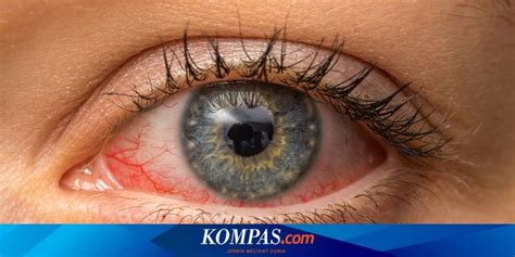 Mata Merah dan Berair