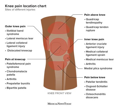 Meniscus Knee Pain Location Chart