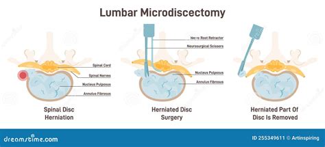 Ilustrasi operasi diskektomi mikro untuk HNP