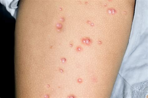 Molluscum Contagiosum