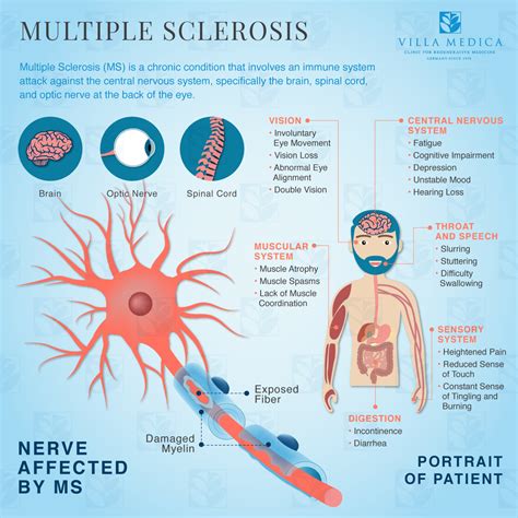Multiple Sclerosis