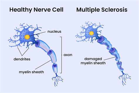 Multiple Sclerosis myelin damage