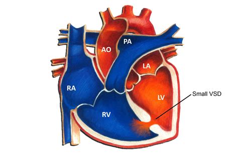 Muscular VSD Heart