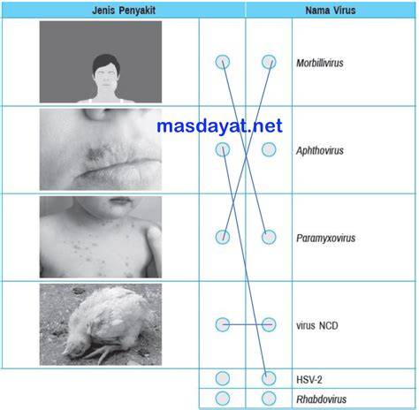 Myalgia akibat infeksi virus