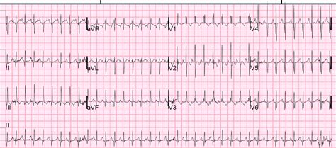Tachycardia ECG