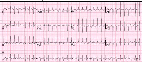 Tachycardia EKG