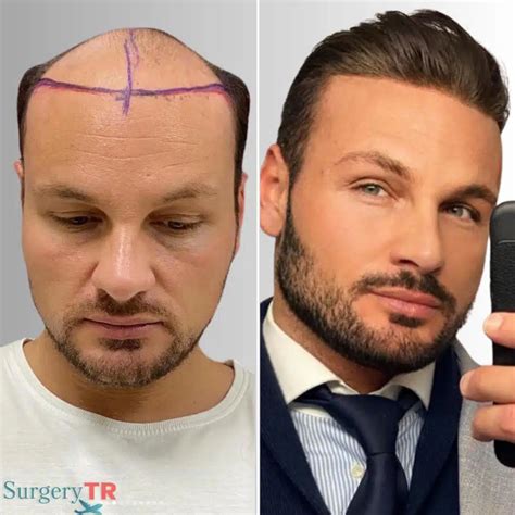 Natural Hair Transplant