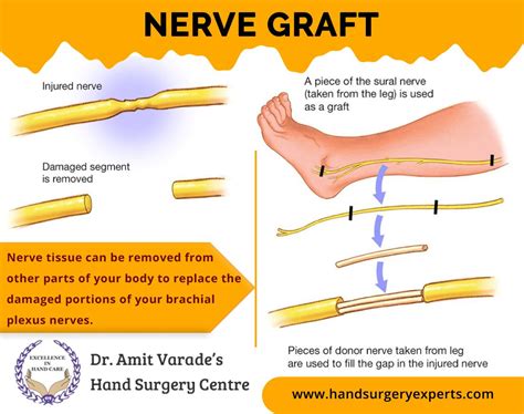 Nerve Graft Surgery