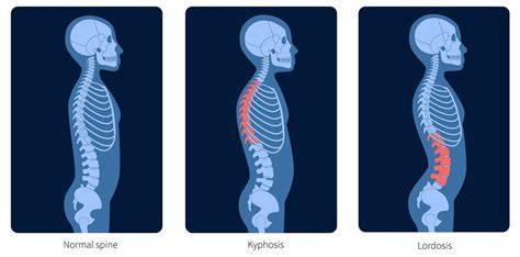 Normal vs Lordotic Spine