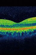 OCT (Optical Coherence Tomography)
