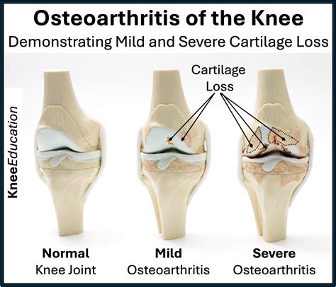 Osteoarthritis