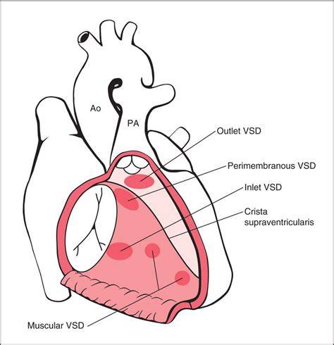 Outlet VSD Heart