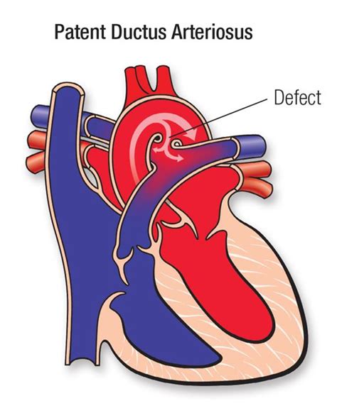 PDA heart defect diagram
