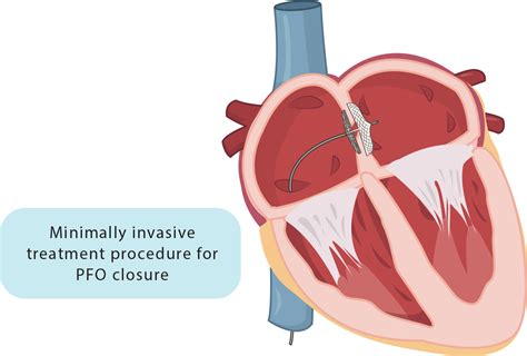 PFO Illustration