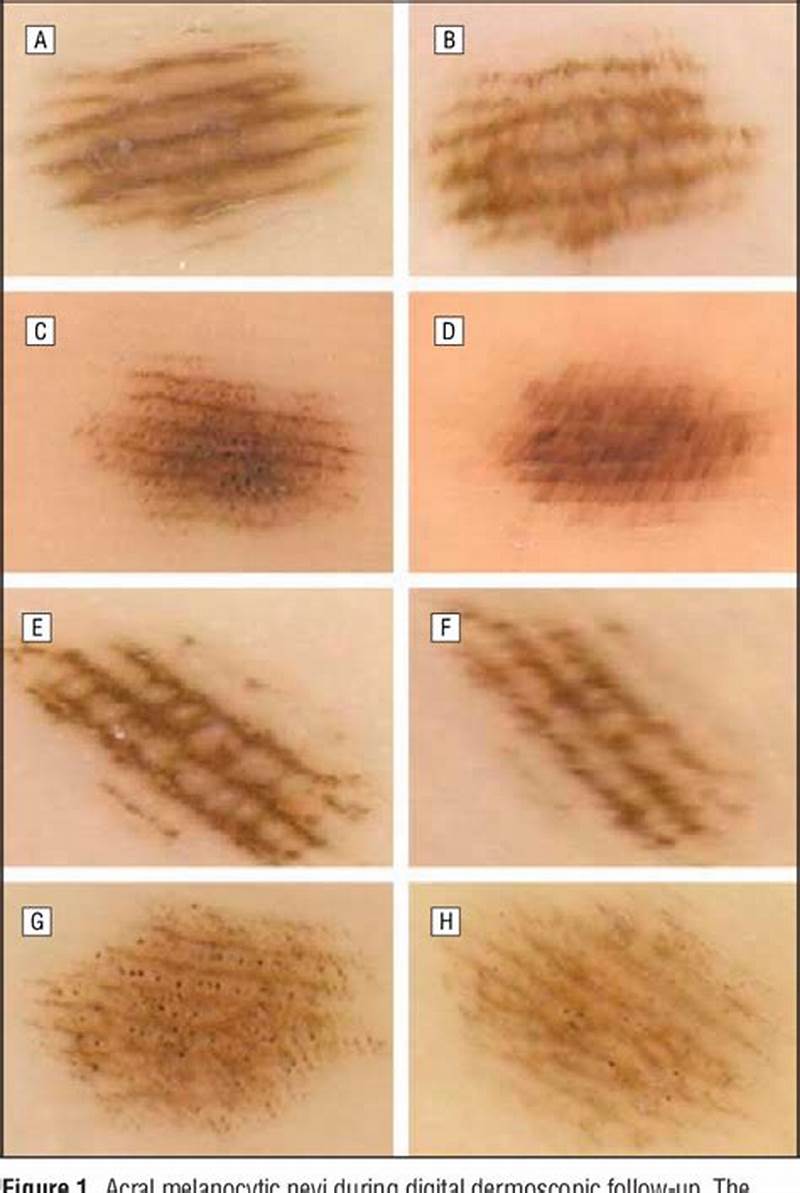 Parallel Furrow Pattern Acral Nevus