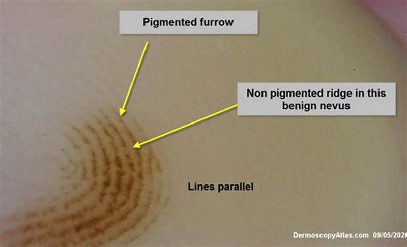 Parallel Ridge Pattern