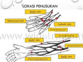 Proses Pemasangan Infus: Langkah Demi Langkah