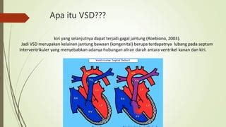Penanganan VSD Obat dan Operasi