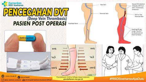Pencegahan DVT
