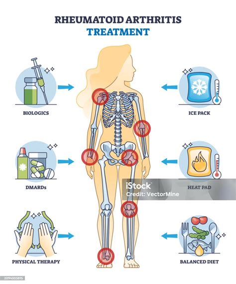 Pengobatan Rheumatoid Arthritis