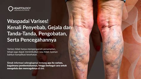 Pengobatan Varises