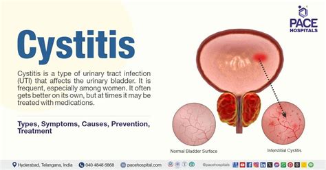 Penyebab Cystitis