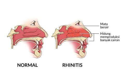 Penyebab Rhinitis Alergi