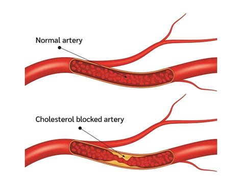 Penyebab arteriosklerosis